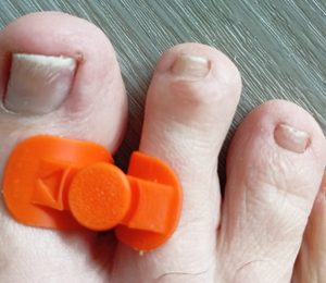 V9 – HALLUX VALGUS